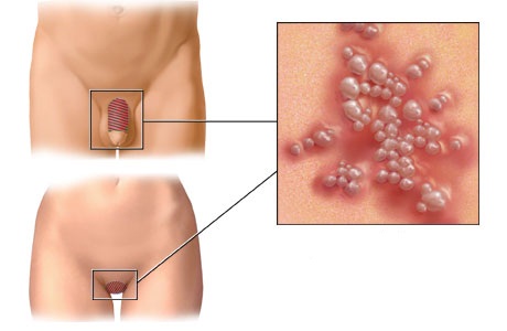 http://www.metodosanticonceptivos.info/wp-content/uploads/2011/11/herpes-genital-simplex.jpg